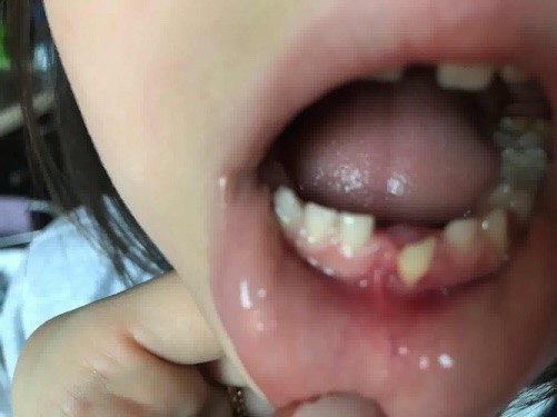 dentino con gengiva scavata infiammata